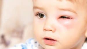 درمان عفونت چشم در کودکان