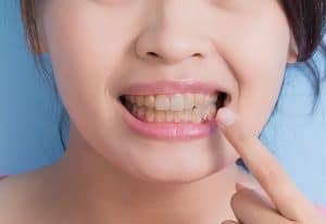 عوارض دندان های زرد