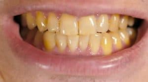 علل بروز دندان های زرد