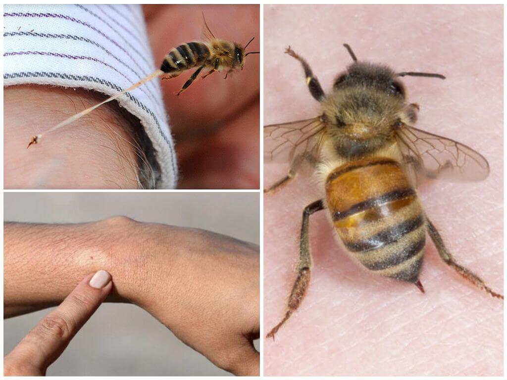 روش های درمان نیش زنبور