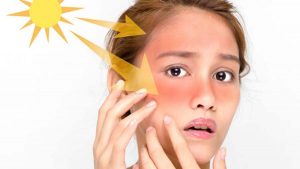 راههای درمان آفتاب سوختگی پوست صورت