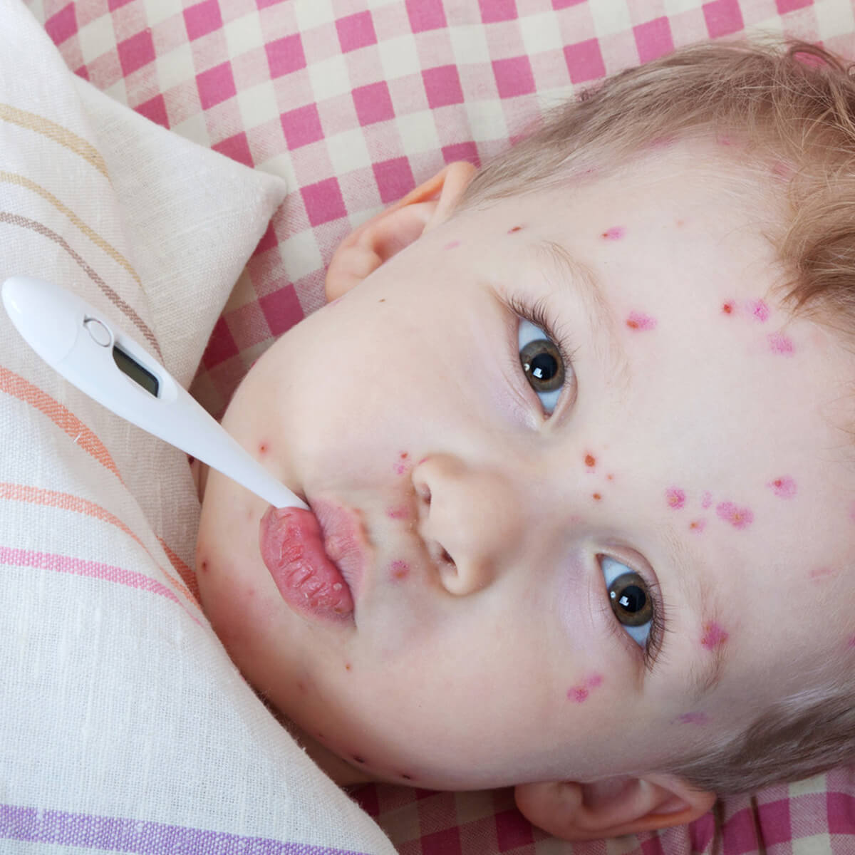 غذاهای مفید آبله مرغان