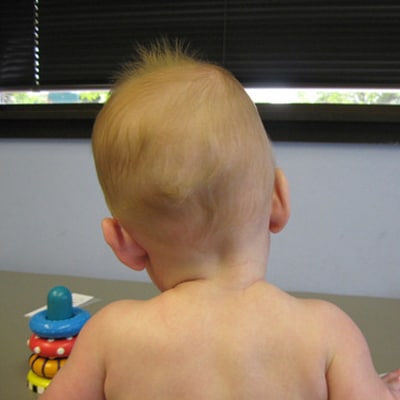 علت کجی گردن در نوزاد و روش درمان آن