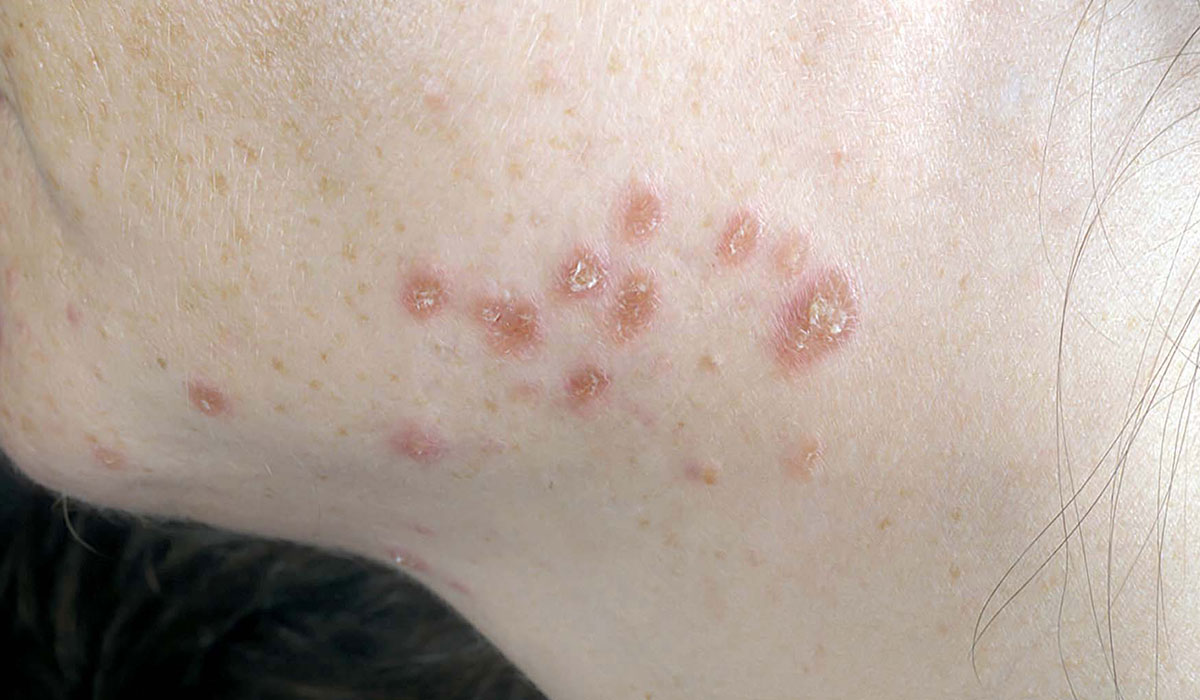 بیماری سارکوئیدوز چیست و چگونه درمان می شود؟