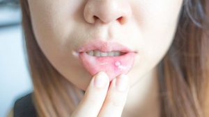 علت آفت دهان در کودکان و درمان آن