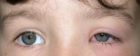تورم باکتریایی چشم نوزاد